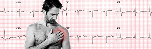 Altérations sur l'électrocardiogramme