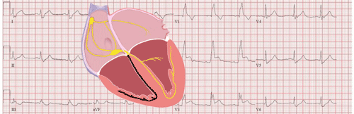 Right Bundle Branch Block