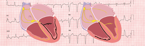 Bundle Branch Blocks