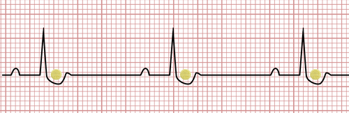 La digoxine dans l'ECG