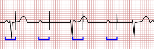 Alterações do Marcapasso no Eletrocardiograma