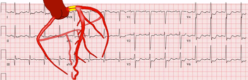 Infarto Agudo do Miocárdio de Diagnóstico Difícil