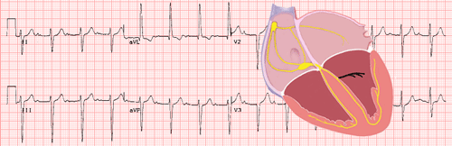 Left Fascicular Blocks