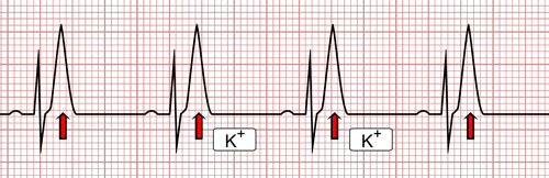 Hipercalemia no ECG