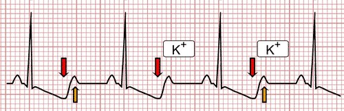 Hypokaliémie et ECG