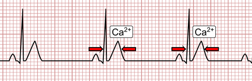 Hypercalcemia on the EKG