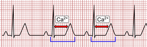 Hypocalcémie sur l'électrocardiogramme