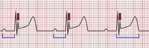 EKG and Hypothermia