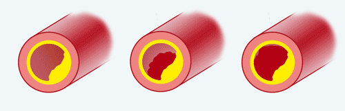 Signes d'ischémie, de lésion et de nécrose sur l'électrocardiogramme