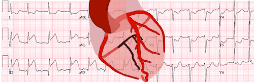 EKG Localization of the Occluded Artery in Acute Myocardial Infarction