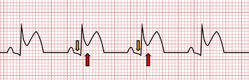 Acute Pericarditis on the EKG