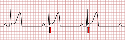 Repolarisation précoce sur l'ECG