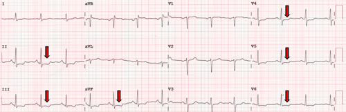 Syndrome coronarien aigu sans sus-décalage du segment ST