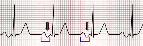 Bayés Syndrome