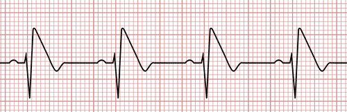 Syndrome de Brugada sur l'électrocardiogramme