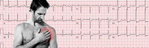 Eletrocardiograma da Síndrome Coronariana Aguda