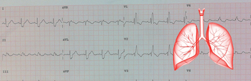 EKG in Pulmonary Embolism