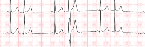 Ashman Phenomenon on the Electrocardiogram