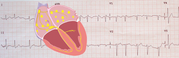 Fibrillation auriculaire dans l'électrocardiogramme