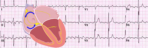 Flutter atrial