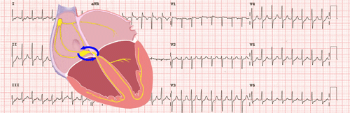 Atrioventricular Nodal Reentrant Tachycardia