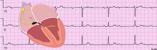 Atrioventricular Blocks