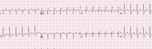 Idiopathic Fascicular Left Ventricular Tachycardia