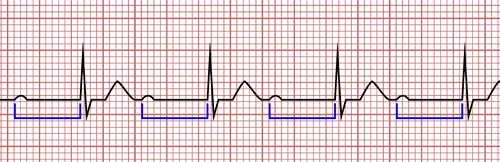 First Degree Atrioventricular Block