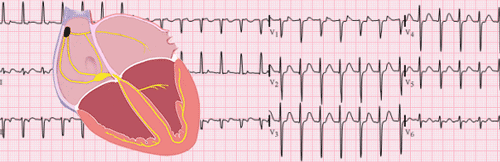 Inappropriate Sinus Tachycardia