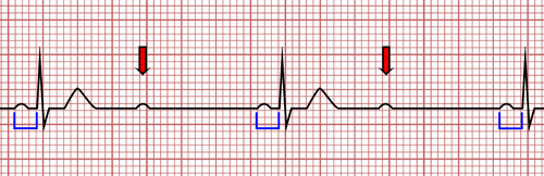 Bloqueo Auriculoventricular de Segundo Grado