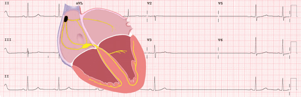 Sick Sinus Syndrome EKG