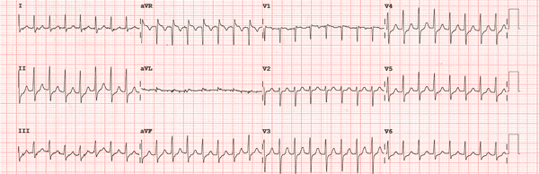 Supraventricular Tachycardias EKG