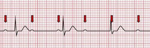 Bloqueio Atrioventricular de Terceiro Grau