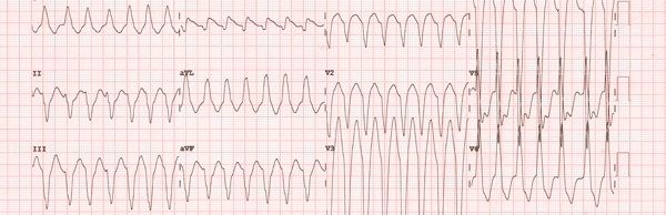 Ventricular Arrhythmias