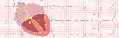 Extrasystoles ventriculaires sur l'ECG