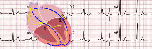 Syndromes de pré-excitation dans l'électrocardiogramme