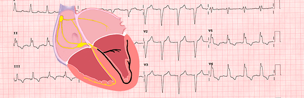 Left Bundle Branch Block