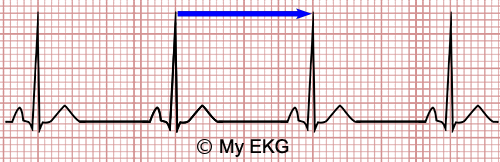 Calculator of Heart Rate on the EKG