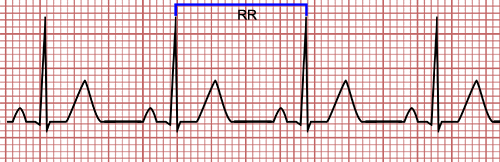 Calculation of R-R Interval