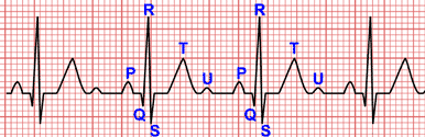 Ondes de l'électrocardiogrammes