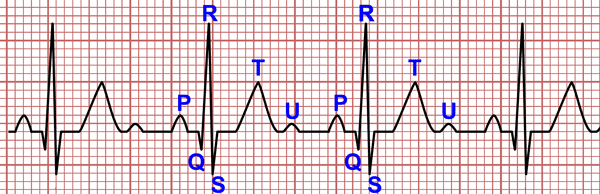 Ondes de l'ECG