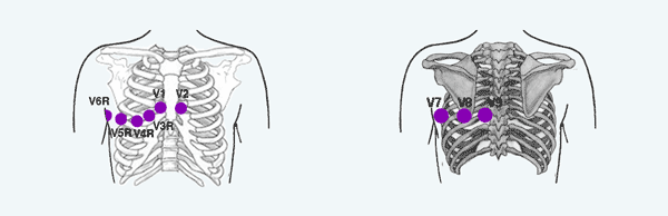 Right-Side Leads and Posterior Leads