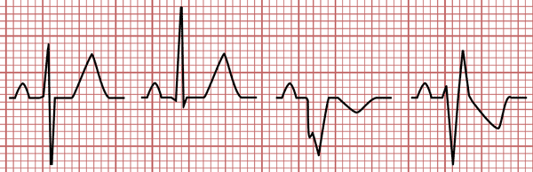 Morphologie du complexe QRS