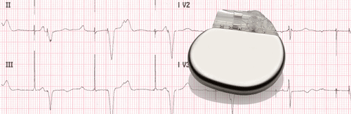 Elettrocardiogramma del pacemaker