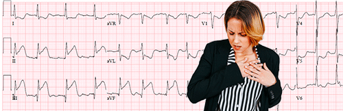 Infarto miocardico con sopraslivellamento del tratto ST