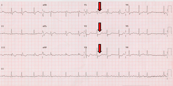 Electrocardiogram of a Posterior Myocardial Infarction