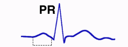 PR Interval