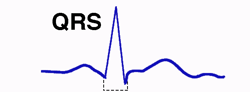 Intervallo QRS