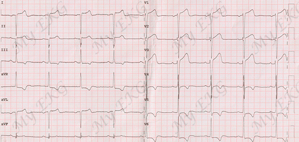 Left and Right Arm Leads Reversal