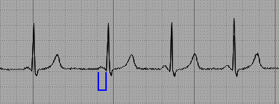 Eletrocardiograma da Síndrome de Lown-Ganong-Levine